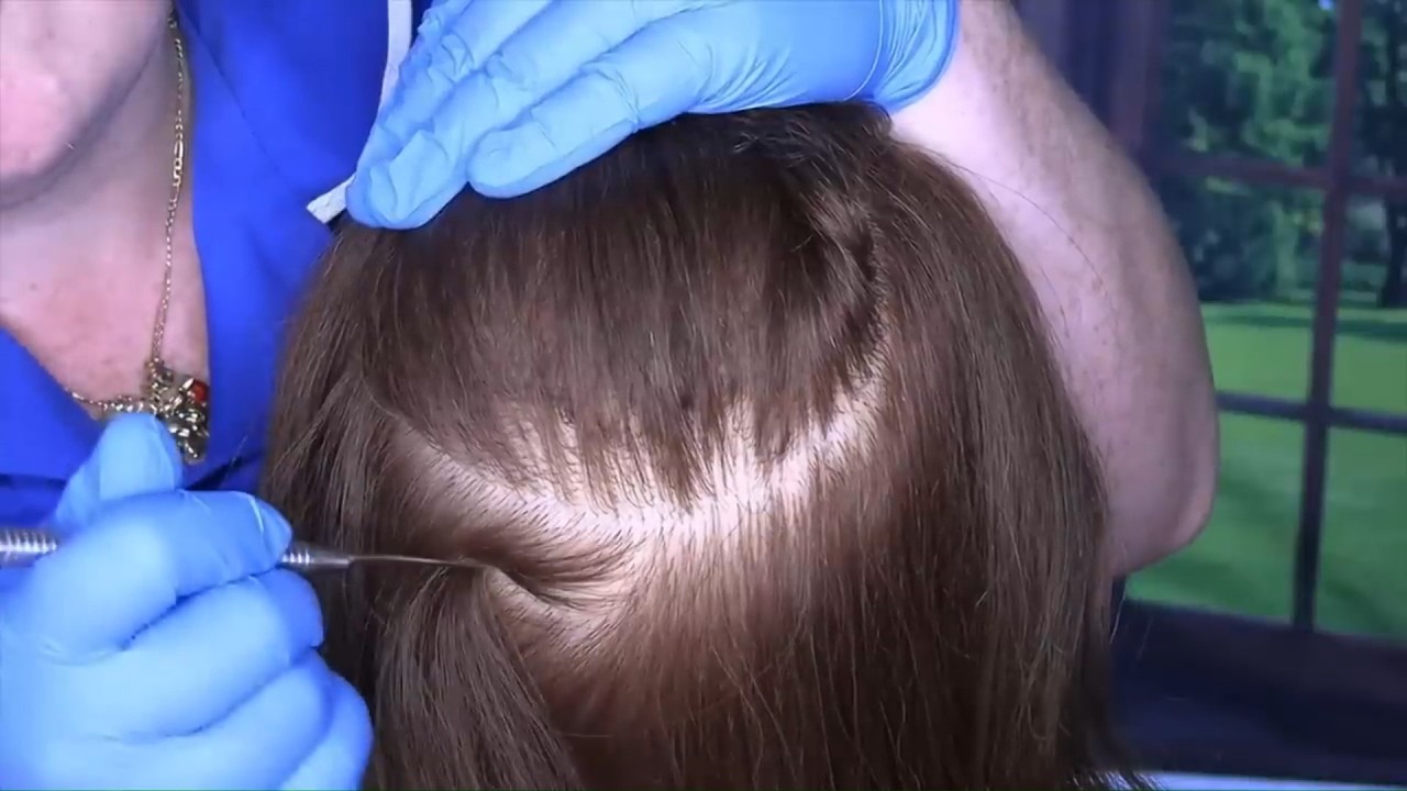 ASMR Scalp Check and Treatment (Scalp Scratching, Whispering) Medical RP