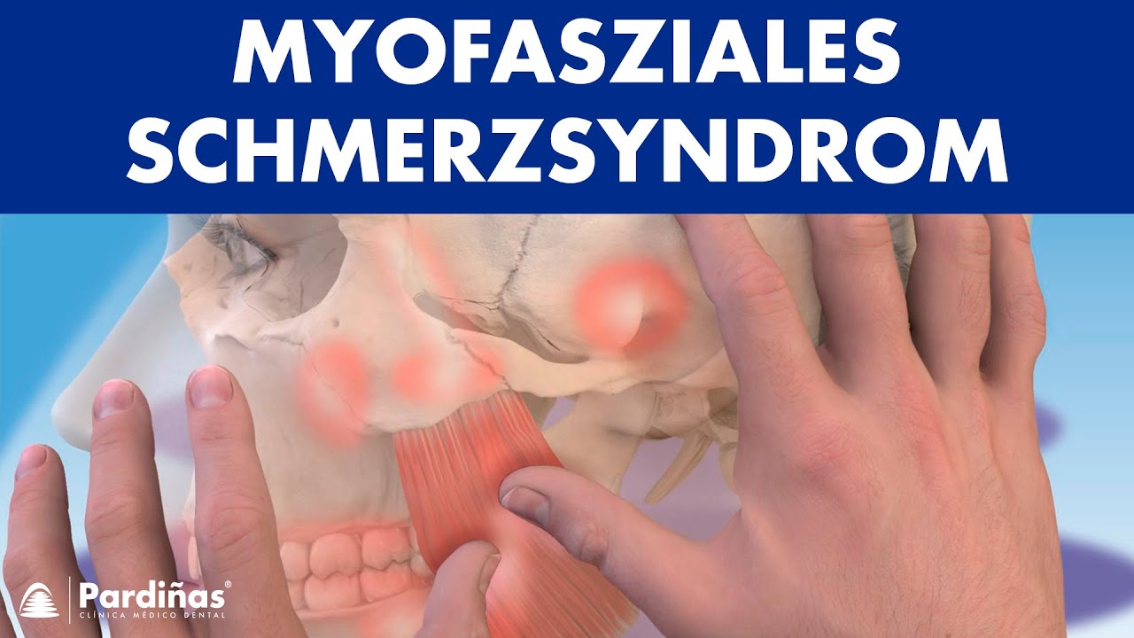 TRIGGERPUNKTE mit Physiotherapie behandeln - Myofasziales Schmerzsyndrom ©