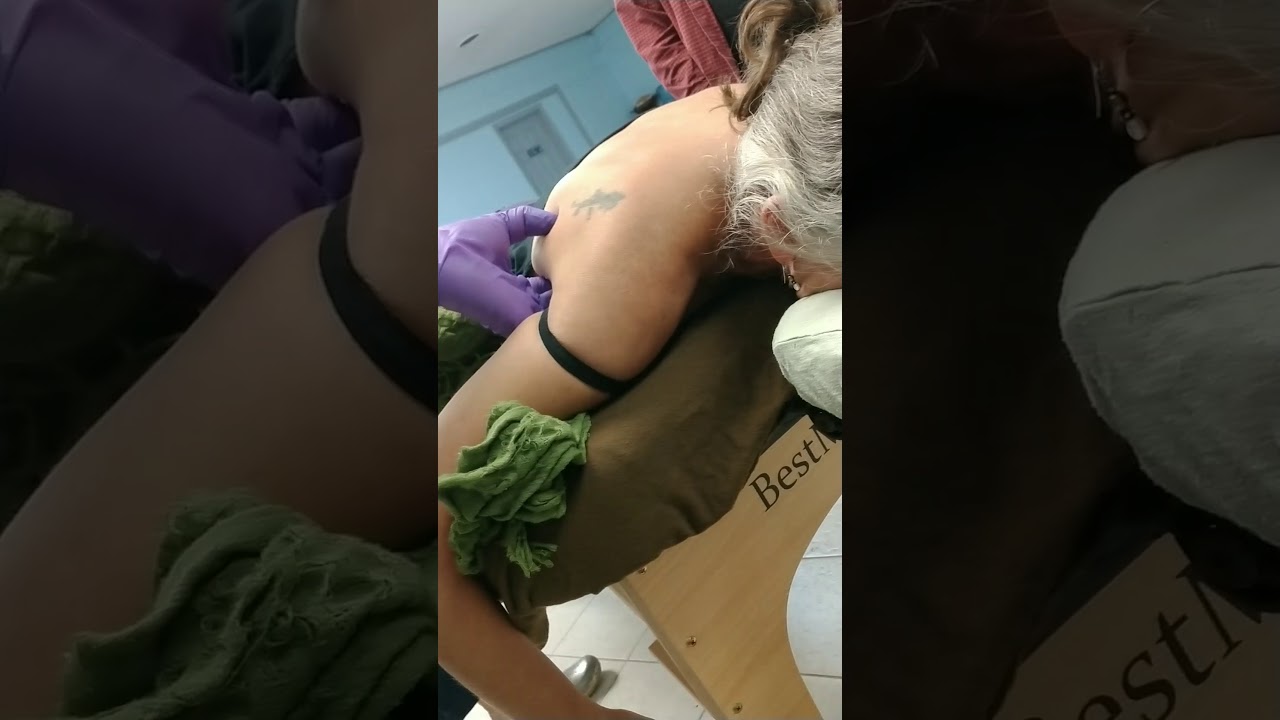 Orthopedic Trigger Point Acupuncture: Dry Needling & Chinese Medicine - Teres Minor / Major