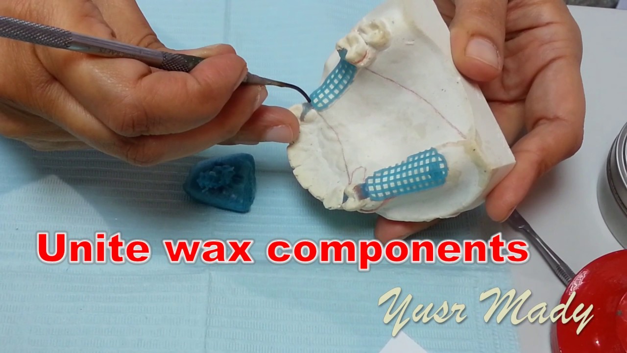 6- Wax Pattern (Maxillary  Class II Modification 1)
