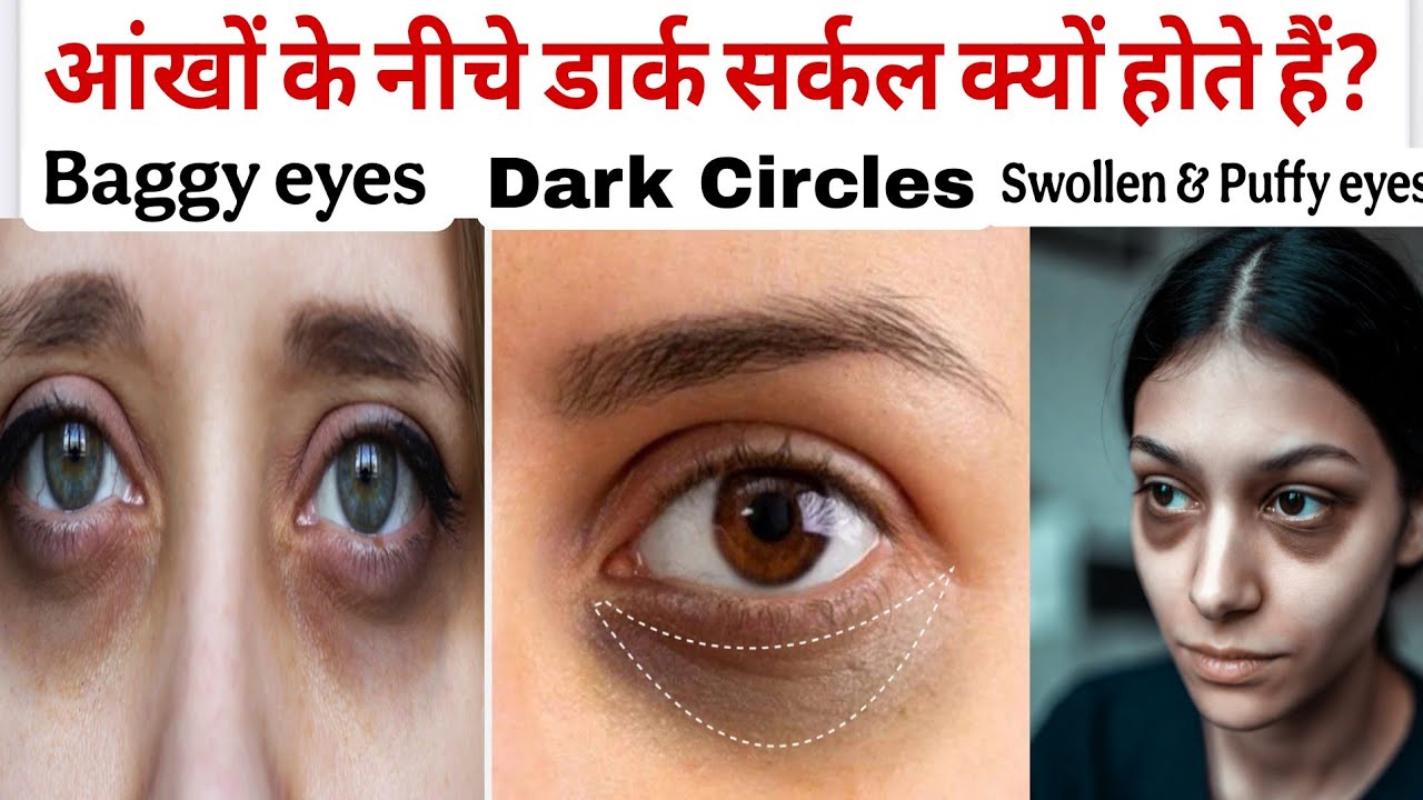 Dark Circles of Eyes, Why do dark circles occur under the eyes?