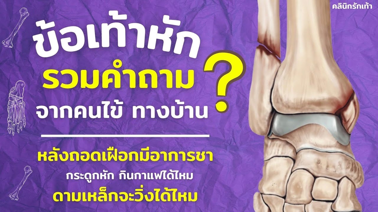 ข้อเท้าหัก รวมคำถาม จากคนไข้ทางบ้าน - เช่น มีอาการชา กินกาแฟได้ไหม เหล็กดามกระดูกหัก เป็นต้น