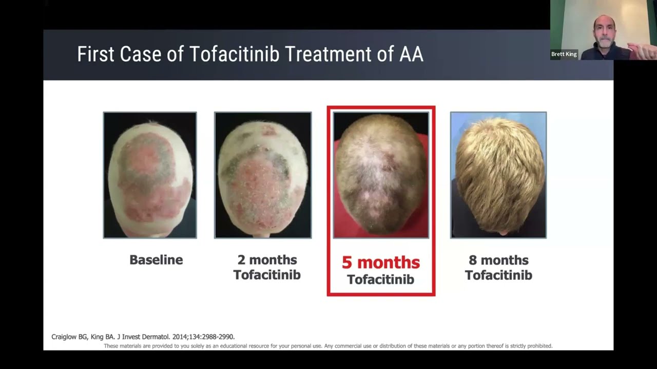 Expectations of JAK inhibitor treatment of alopecia areata