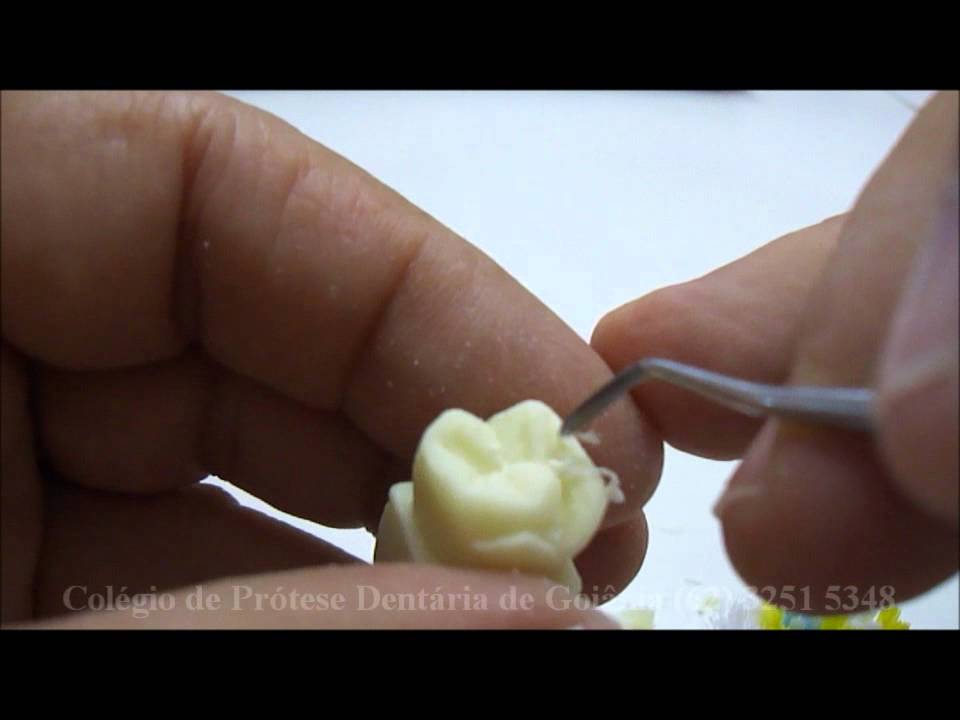 Enceramento Regressivo Dente 26