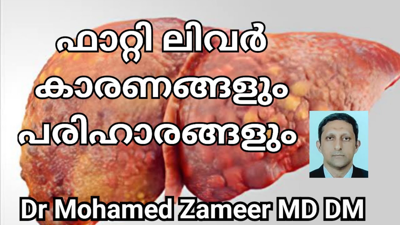 Fatty liver malayalam,ഫാറ്റി ലിവർ ട്രീറ്റ്മെന്റ് മലയാളം,ഫാറ്റി ലിവർ മാറാൻ