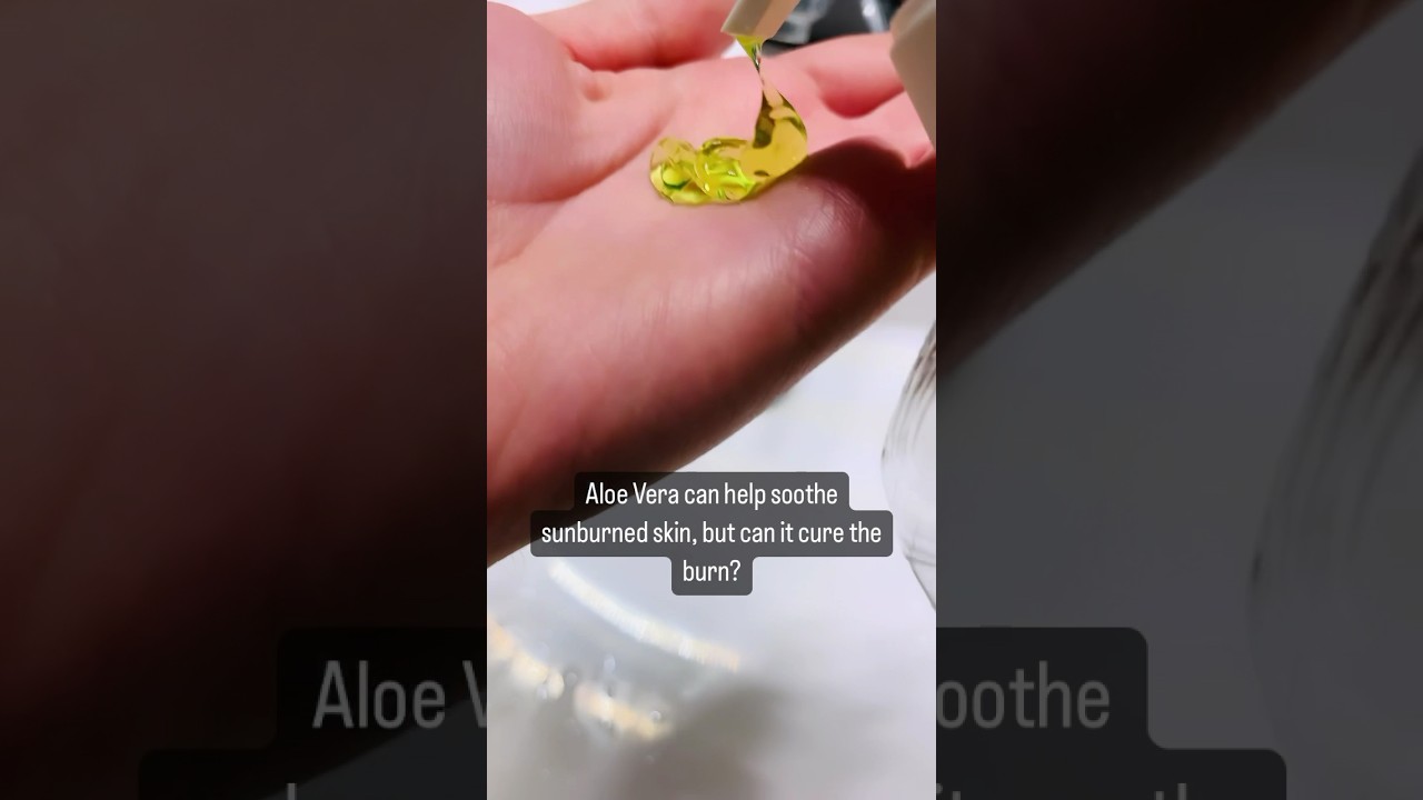 Does aloe vera help with sunburns?