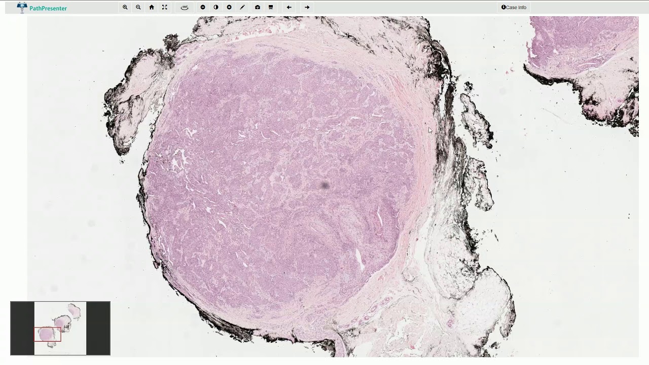 Glomus Tumor - Histopathology