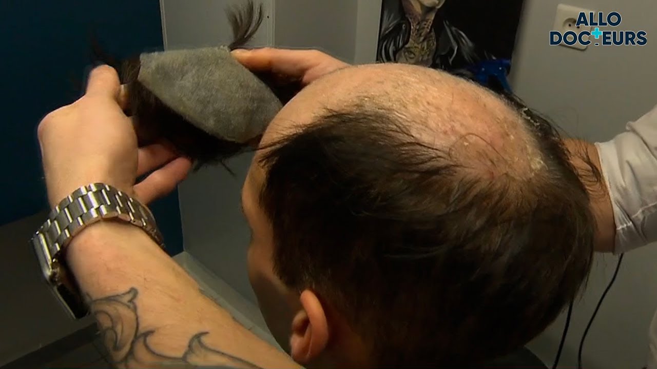 CALVITIE : une solution MIRACLE ?