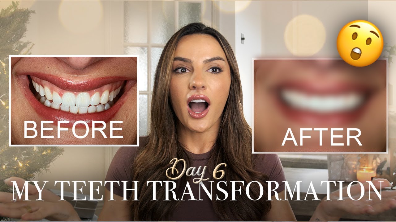 MY TEETH TRANSFORMATION // MY FAVORITE KRISMAS GIVEAWAY | KRISMAS - DAY 6