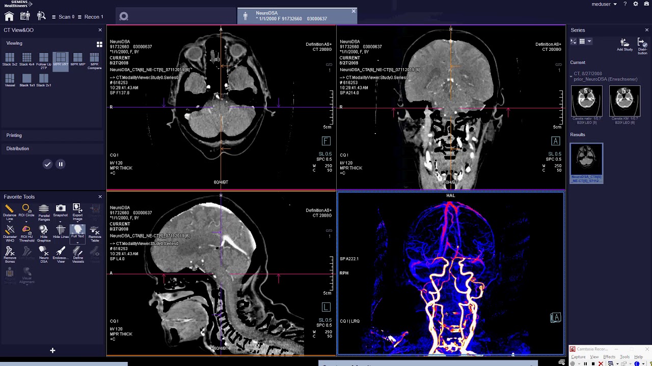 Neuro DSA  - برنامج لفصل العظام عن الصبغه