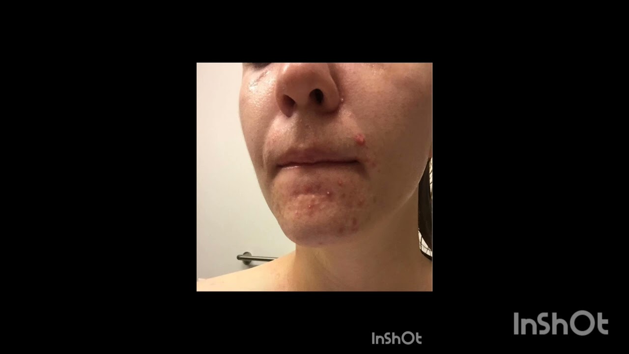 Best Skin Cleanser for Oily and Combination Skin Type! #skin #skincare #skincareroutine #oilyskin 