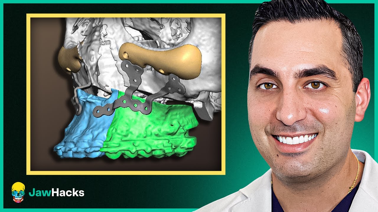 Custom PEEK Implants for Midface Enhancement
