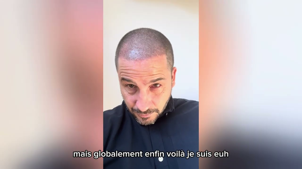 10 jours après ma transplantation capillaire à la clinique COSMEDICA