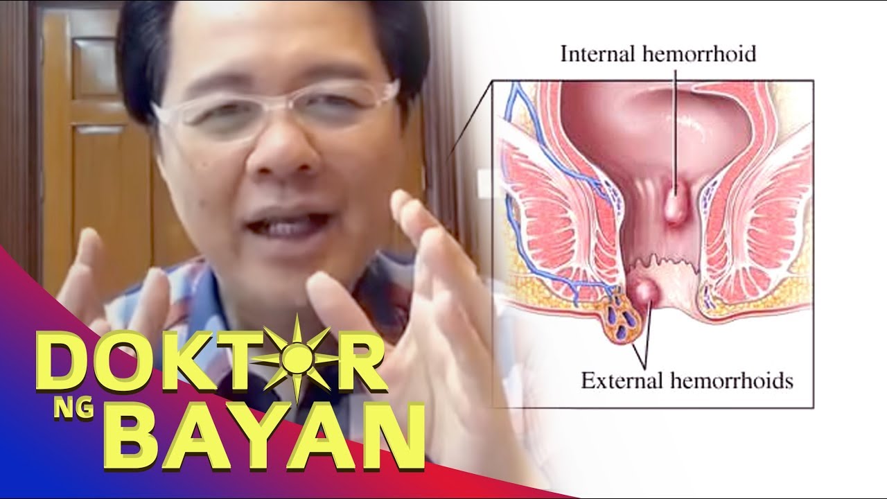 ALMORANAS: Hirap sa Pagdumi- ni Doc Willie Ong LIVE #268b
