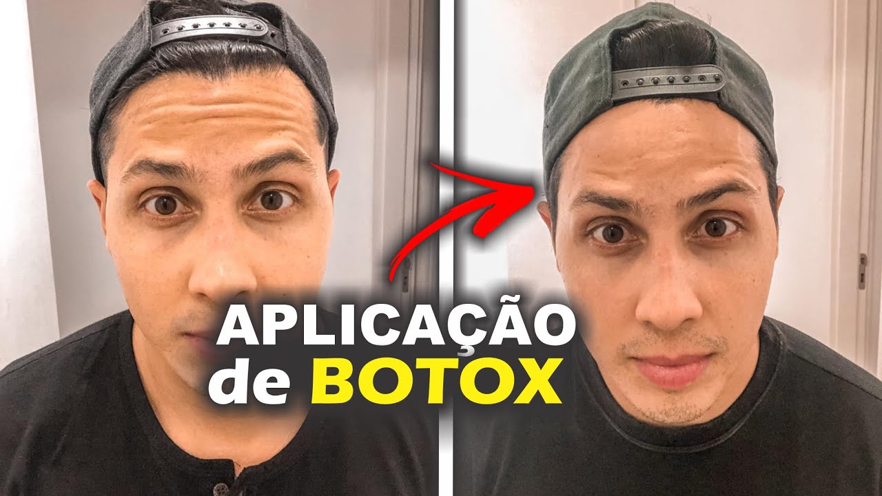BOTOX, Antes e Depois. QUANTO CUSTA? 