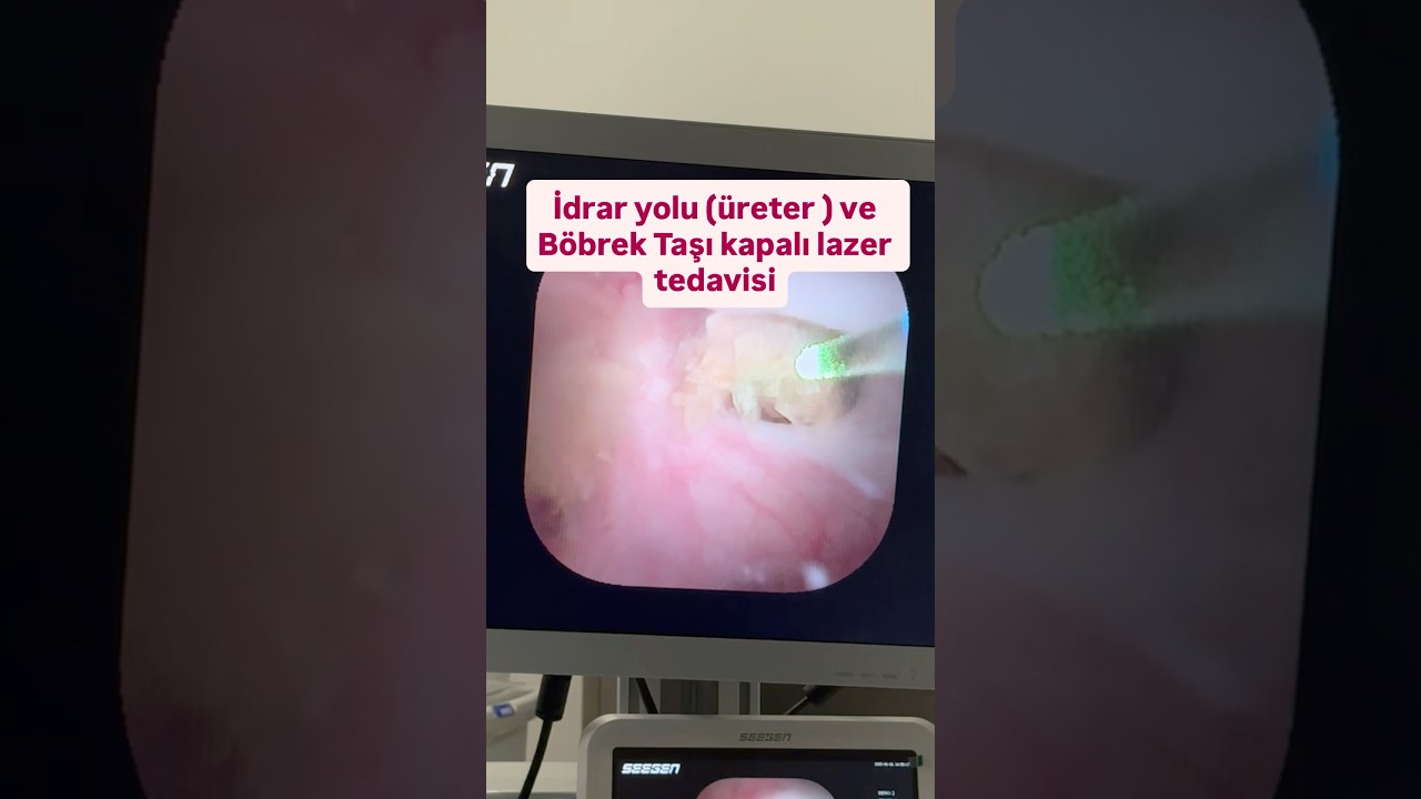 İdrar yolu (&uuml;reter ) ve b&ouml;brek taşı kapalı lazer tedavisi / Do&ccedil; Dr Uygar Mi&ccedil;ooğulları