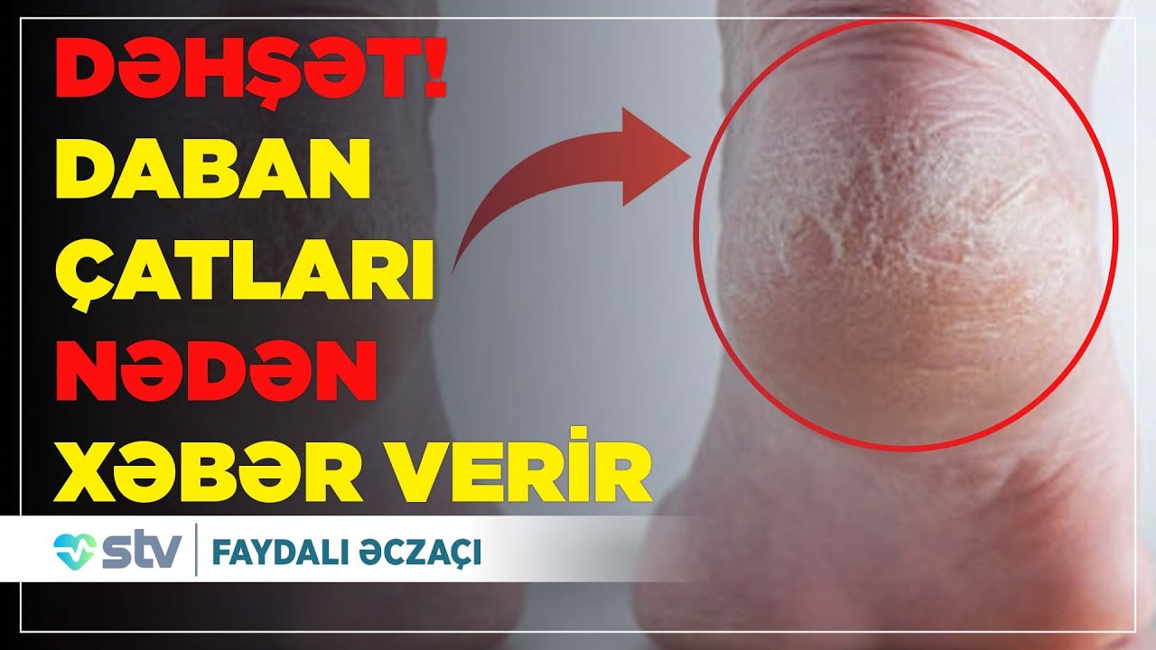 ŞOK! Dabanda çatlar nədən yaranır ?