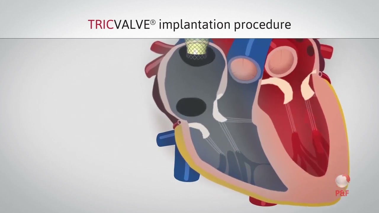 TricValve Implantation - Sistema Bicaval percutáneo para enfermedad tricuspidea.