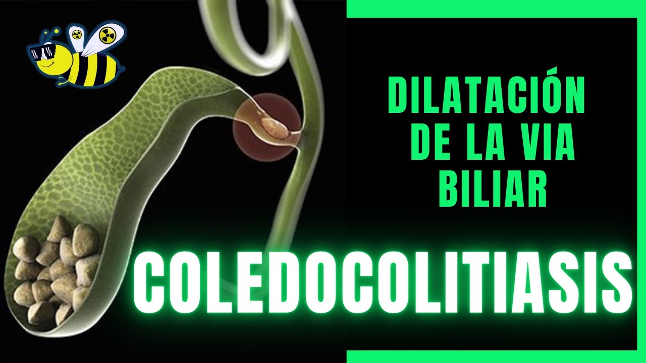 🟢▶️🪨Coledocolitiasis y dilatación de la vía biliar⚠️🪨⚠️ (CASO RADIOLOGICO)