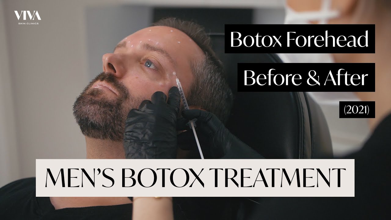 Botox Forehead Before and After (2021) | Men's Botox Treatment