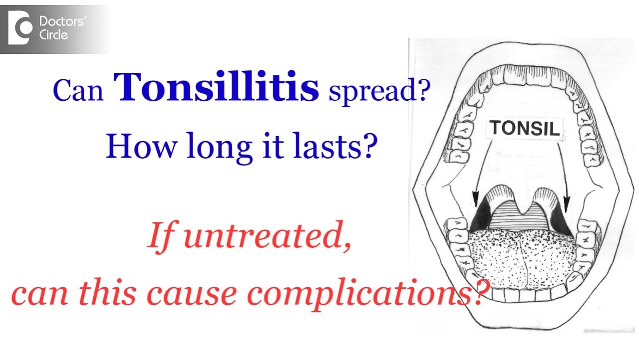 Bacterial tonsillitis | Viral tonsillitis | Untreated tonsillitis complications
