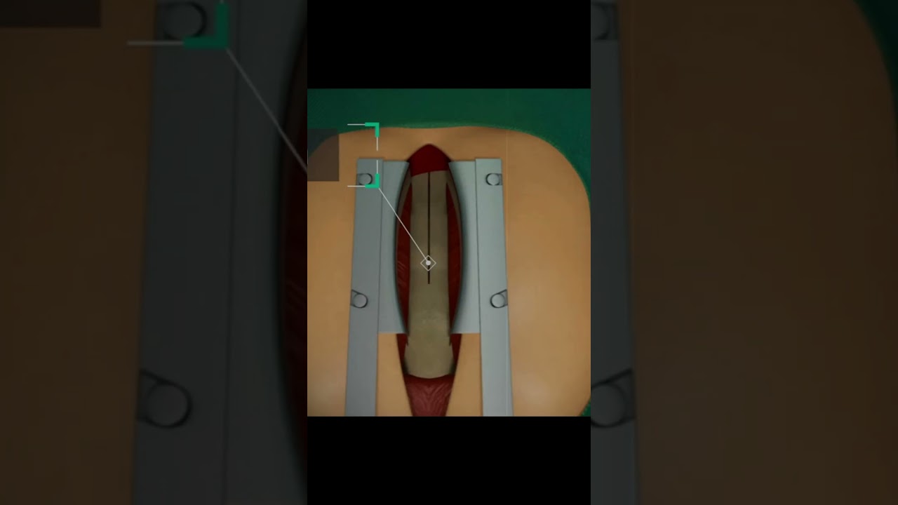 Heart Bypass Surgery Explained in 3D Animation - Save a Life