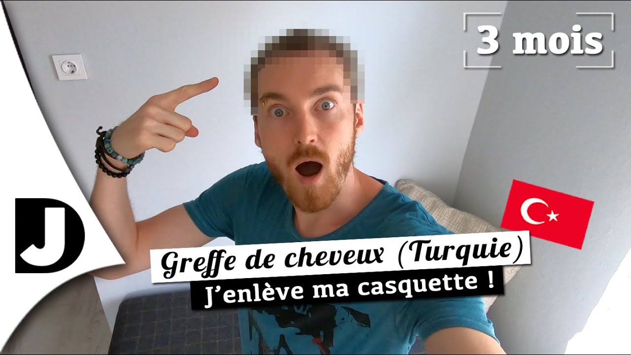 🇹🇷 [GREFFE de CHEVEUX 3 MOIS] Je ne m'attendais pas à ça ! 😧
