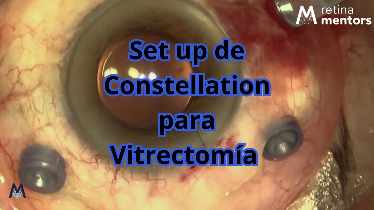 Set up de Constellation para Vitrectomía