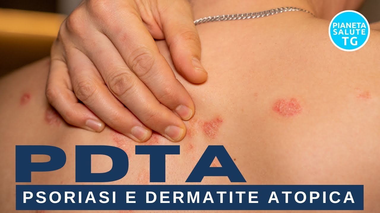Psoriasi e Dermatite Atopica: Nuovi Percorsi di Cura e il Ruolo del PDTA