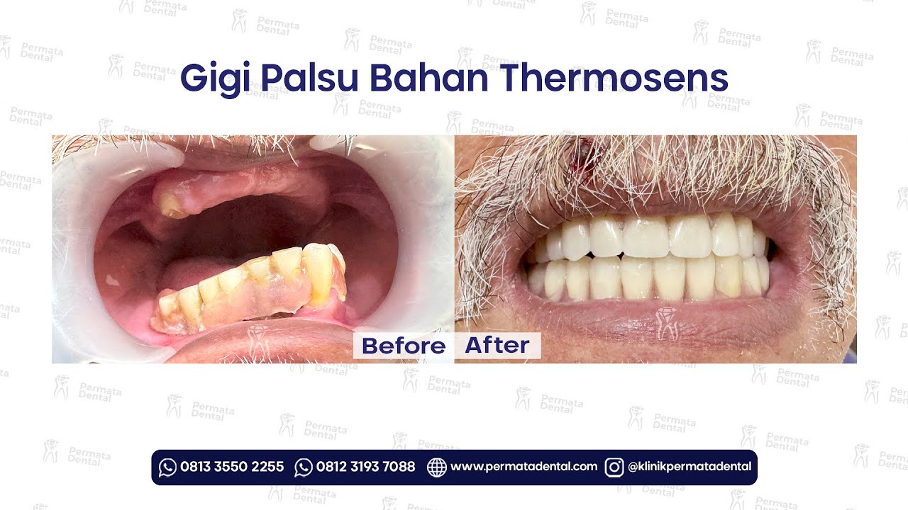 Proses Pemasangan Gigi Palsu Bahan Thermosens Rahang Atas & Bawah (Full Denture) di Permata Dental