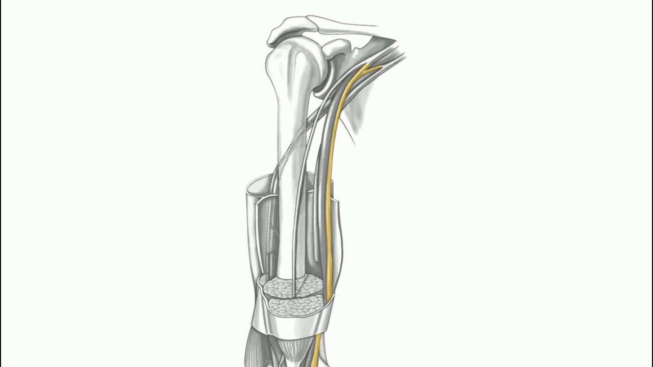 Nerves and Neuropathies of the Upper Limb