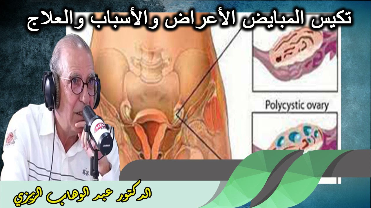 تكيس المبايض الأعراض والأسباب والعلاج الدكتور عبد االوهاب الزيزي