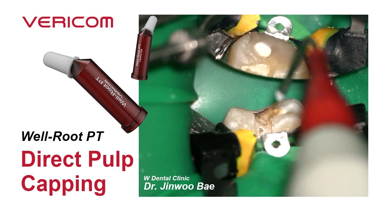 Well-Root PT Direct Pulp Capping