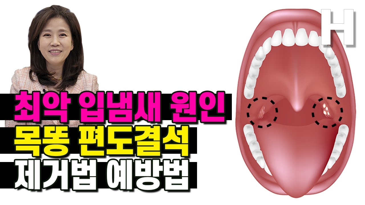 입냄새 원인 목똥 편도결석 제거법 예방법 편도결석도 병인가요?