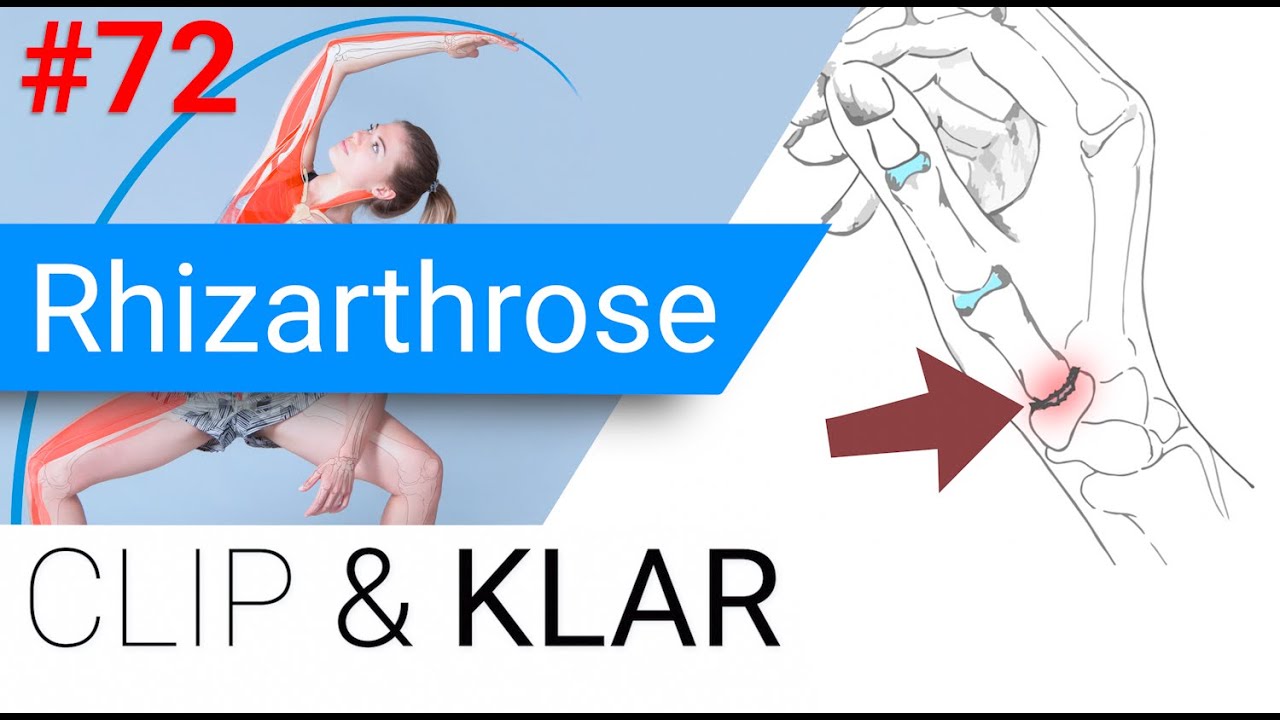 Rhizarthrose erkl&auml;rt - Daumen-Rodeo