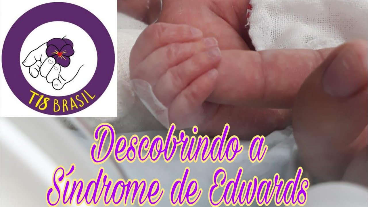 Como descobri a Síndrome de Edwards #t18