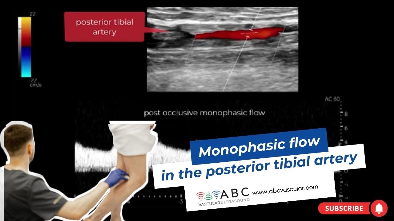Monophasic flow in the posterior tibial artery | Ultrasound