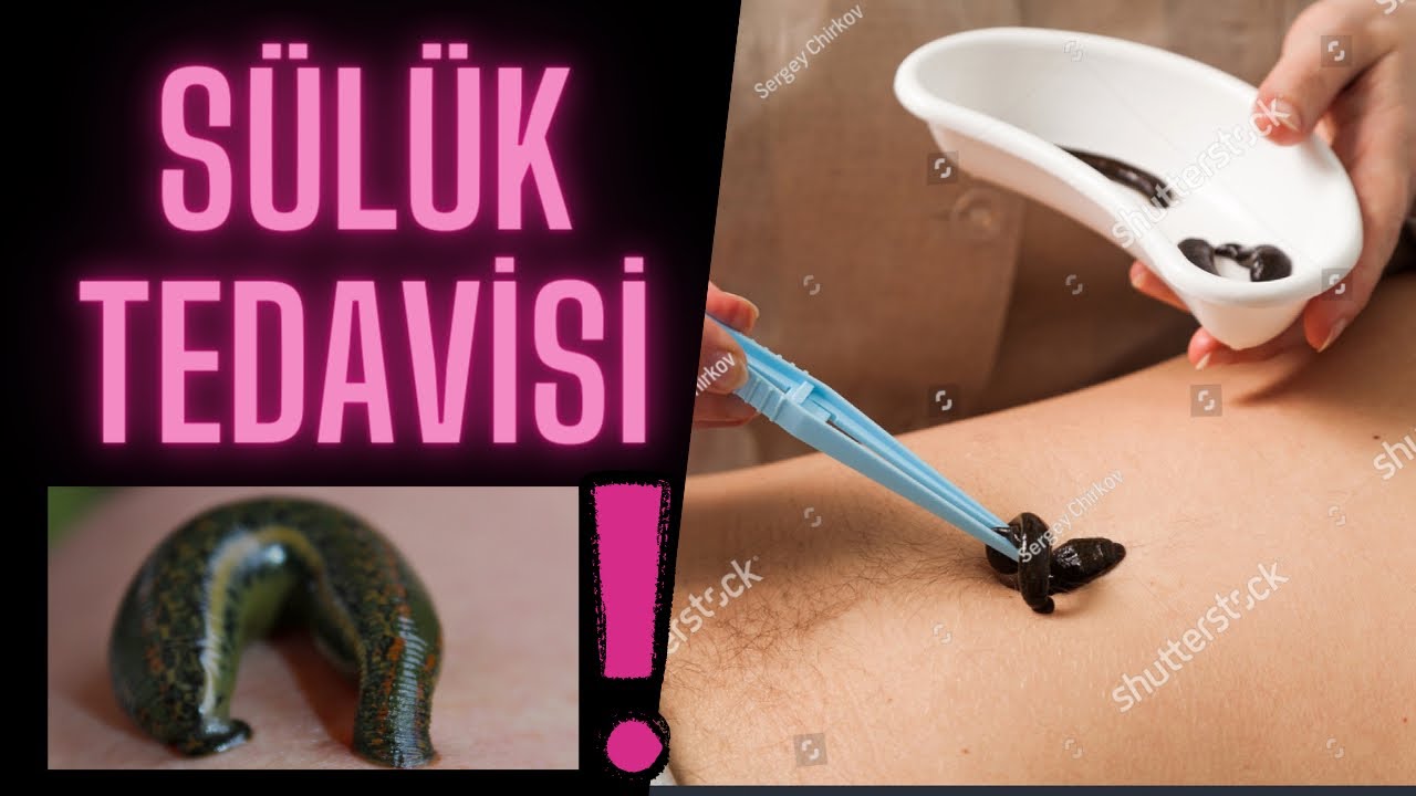Sülük tedavisi öldürebilir ‼️(sülük tedavisi nasıl yapılır-sülük tedavisi faydaları)