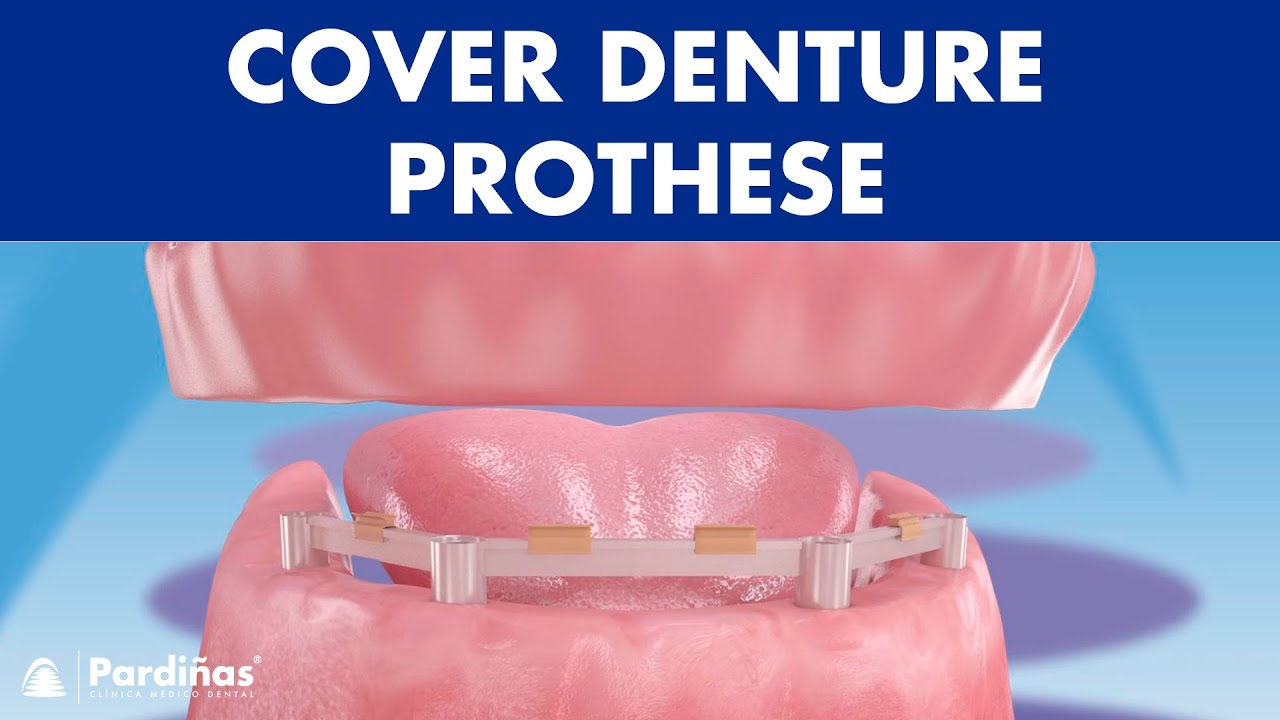 Cover-Denture-Prothese ©