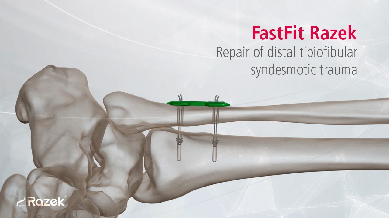 FastFit Razek - Repair of distal tibiofibular syndesmotic trauma