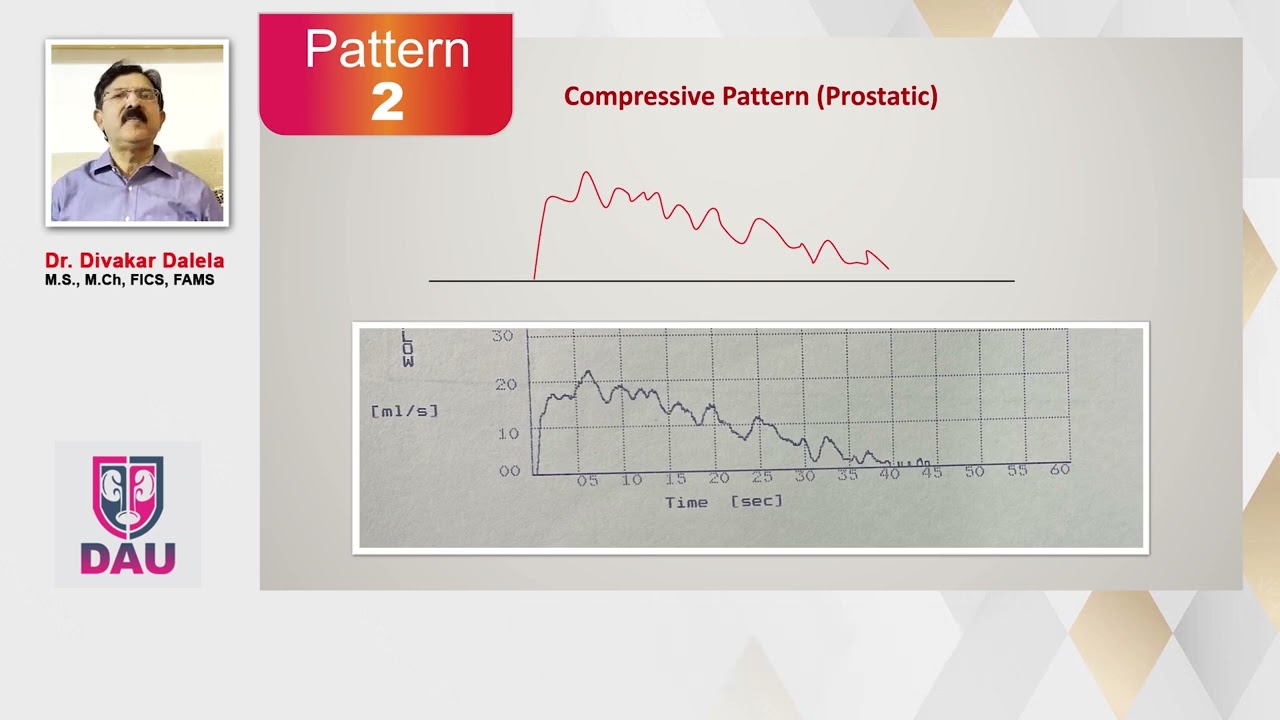 Uroflowmetry How to interpret Flow Patterns