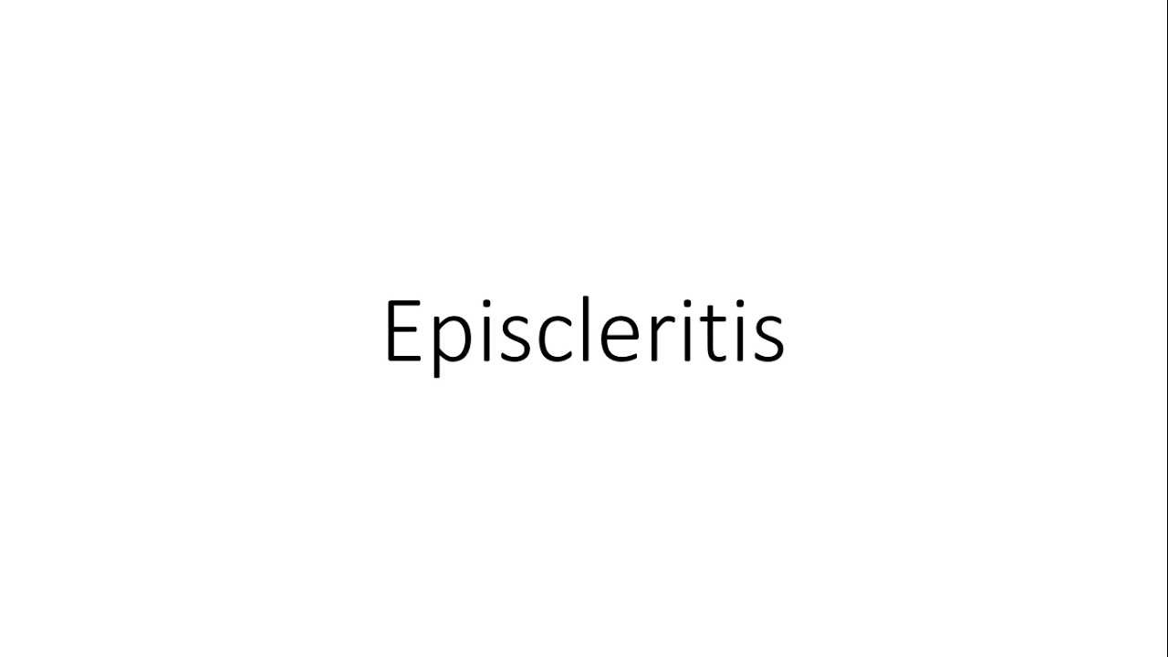 Episcleritis - Ophthalmology
