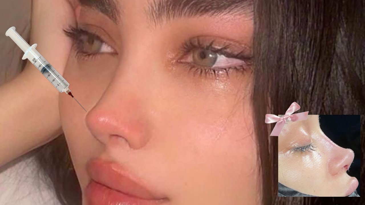 turkish rhinoplasty procedure 💉super snatched ⊹ slim nose (experimental) ୨ৎ 