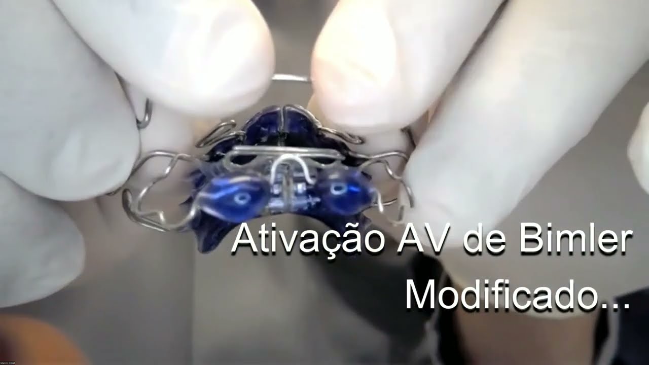 AV Bimler Modificado