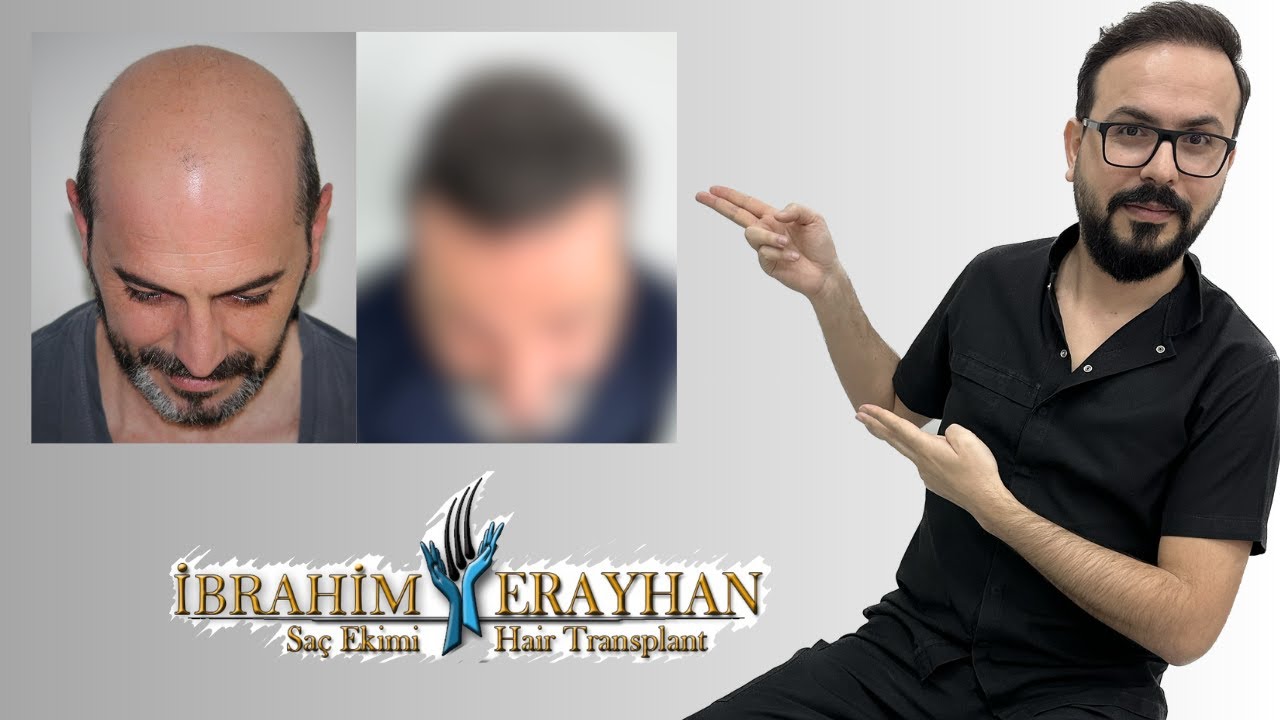 Çok Merak Edilen 2. Seans Saç Ekim Sonucu Sizlerle