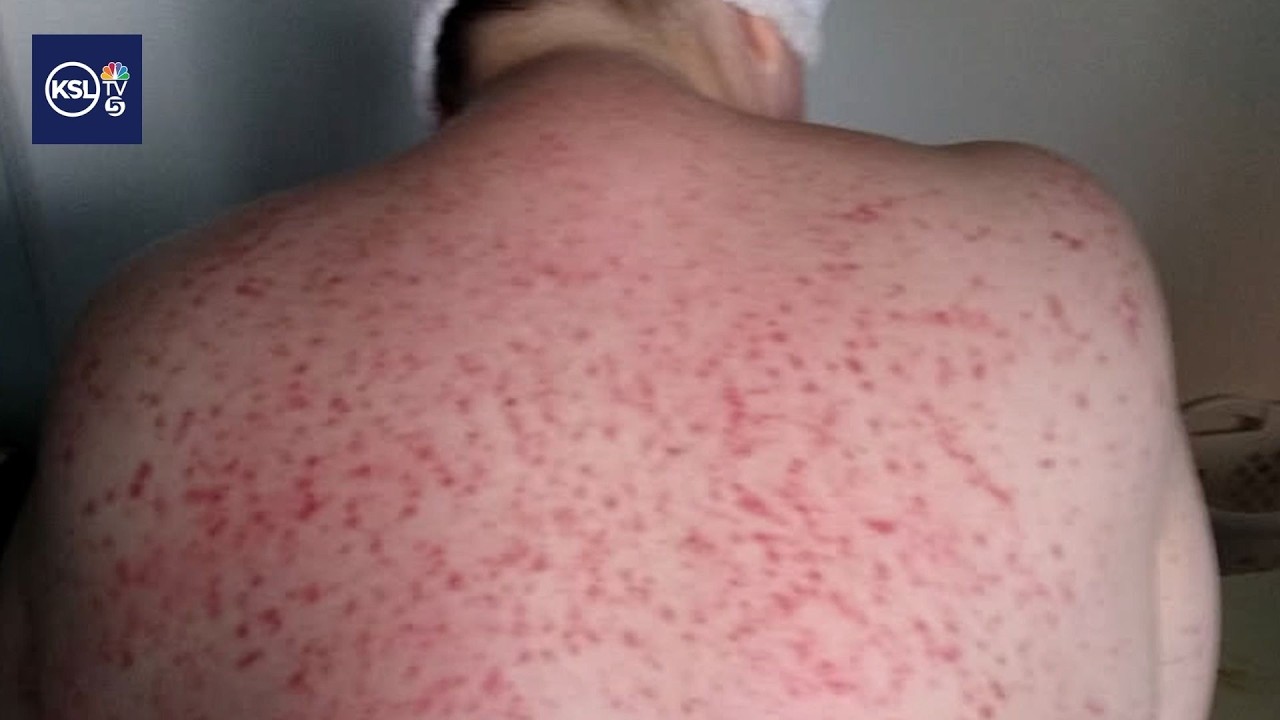 Utah woman's allergy-like symptoms turn out to be rare disease