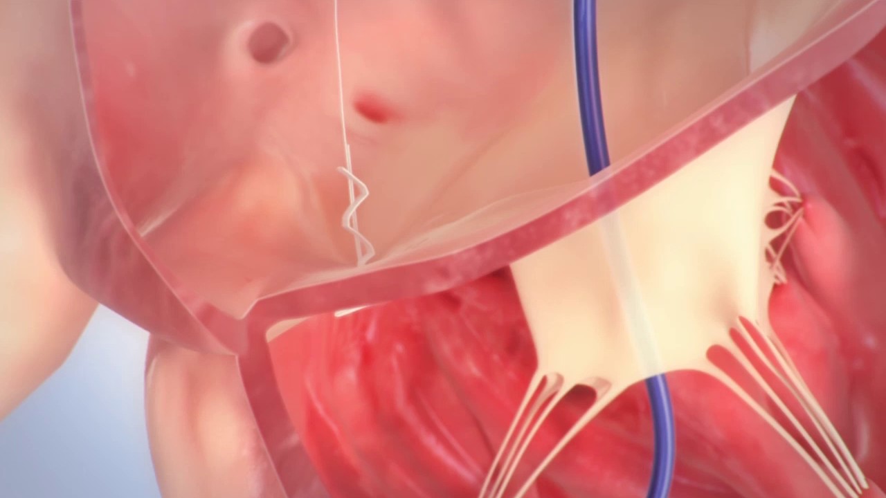 Trialign Tricuspid Valve Repair Animation