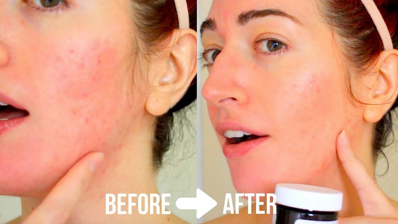 BANISH ACNE SCARS: Review & TEST | Pumpkin Enzyme Mask VS Activated Charcoal Mask
