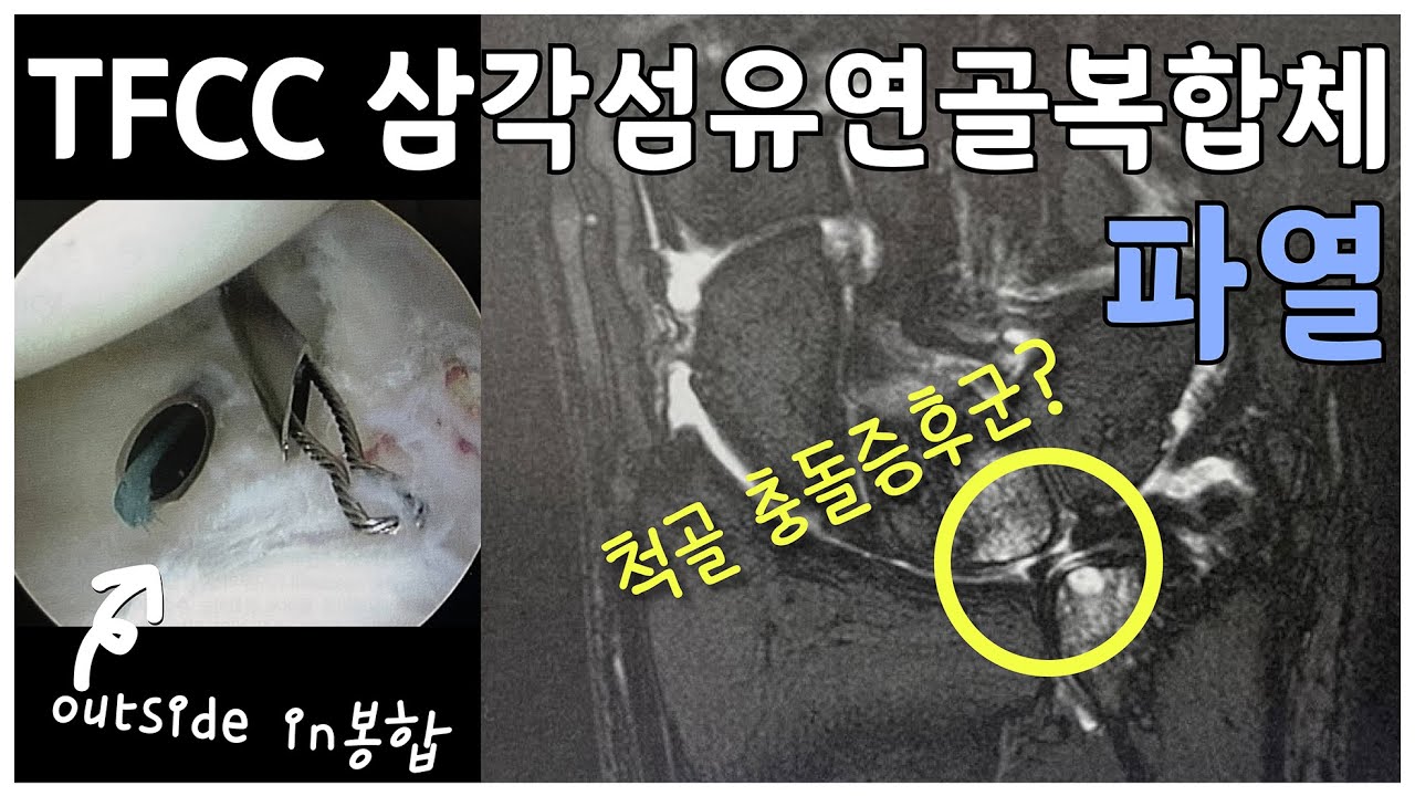 TFCC 삼각섬유연골복합체 시리즈 11 - outside in봉합, 논문, 재활