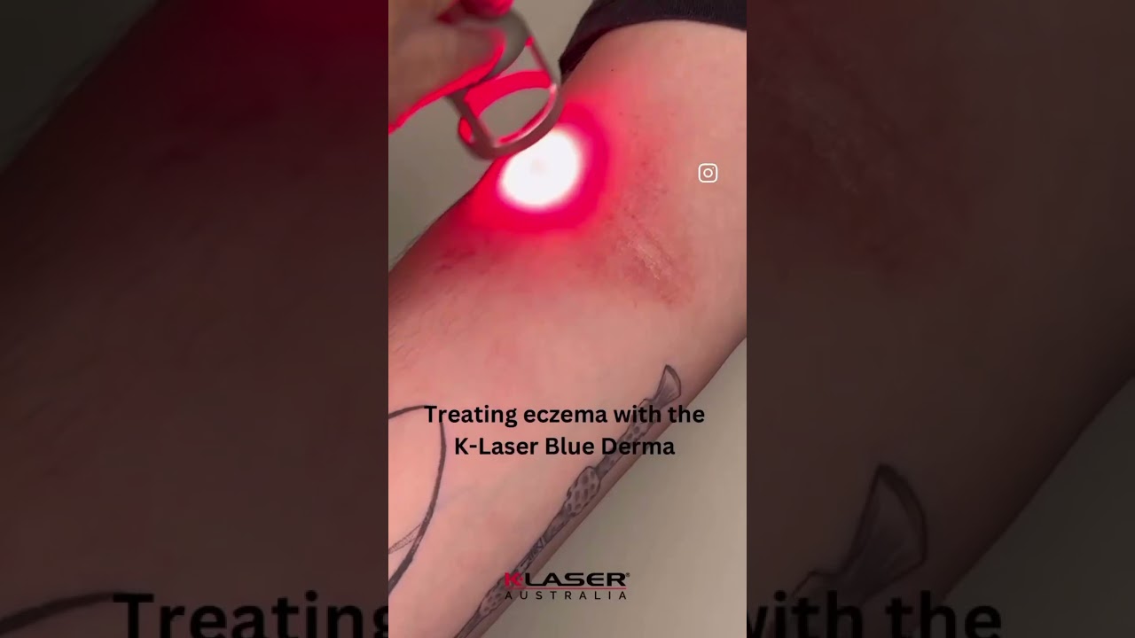 Eczema relief with K-Laser Therapy. Pain free. Drug free. Manage itchiness and redness